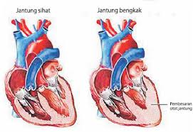 Pengobatan Jantung Bengkak Tanpa Efek Samping